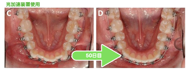 光加速装置使用　50日目