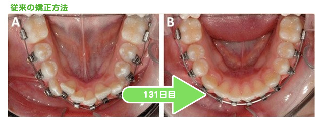 従来の矯正方法　131日目