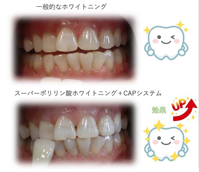 一般的なホワイトニング・スーパーポリリン酸ホワイトニング+CAPシステム